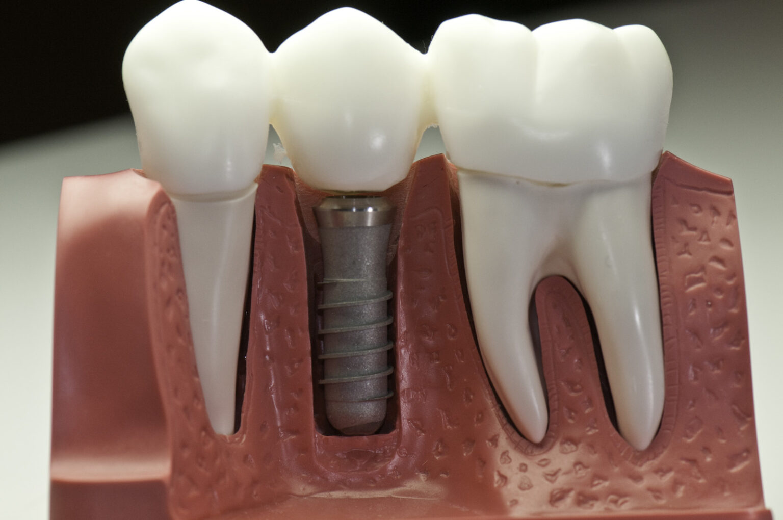 dental-implants-in-ambleside